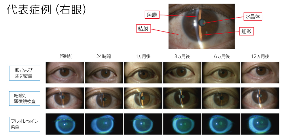 222nm紫外線を室内で照射した際の眼の長期安全性と病原微生物不活化
