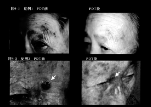 日光角化症に対する光線力学療法             Successful treatment of photodynamic therapy for solar ker atosis